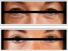 blepharoplastie traitant les paupieres supérieures et inférieures