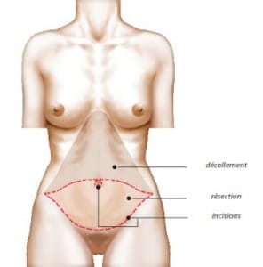 Principe de l'abdominoplastie et explication de la cicatrice abdominale inférieure
