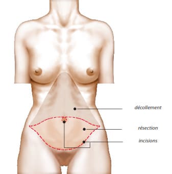 Principe de l'abdominoplastie avec repositionnement ombilical