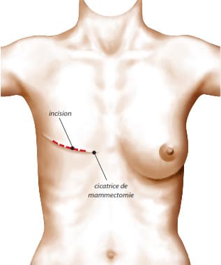 Cicatrice laissée par la mastectomie
