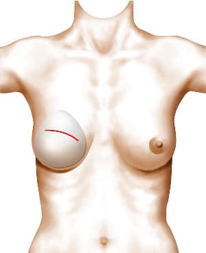 Emplacement de la cicatrice après la pose de l'implant