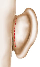 Cicatrice de l'otoplastie (localisation retro-auriculaire)