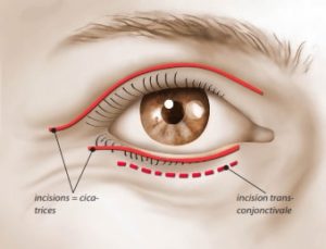 Les incisions pour une blépharoplastie (l'incision trans-conjonctivale est une technique sans cicatrice)