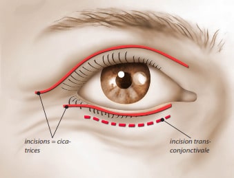 Les incisions pour une blépharoplastie