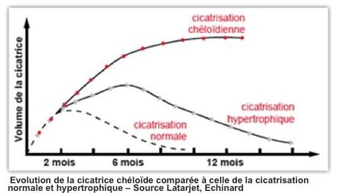 Cicatrice normale hypertrophique et chéloide