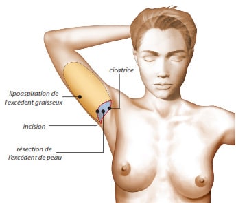 Lifting des bras avec incision horizontale
