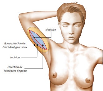 Lifting des bras avec incision longitudinale