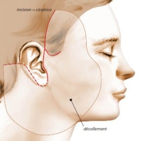 Cicatrices du lifting (du visage ou) cervico-facial (variante selon la position de la patte chevelue)
