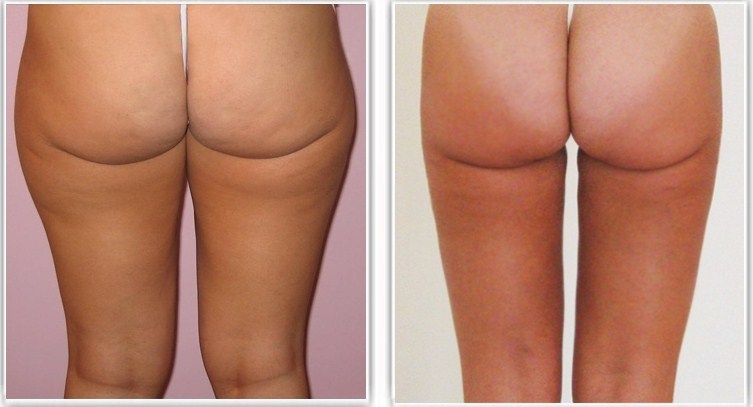 Lipoaspiration des cuisses et de la culotte de cheval (avec genoux)