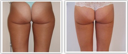 Liposuccion des cuisses avec la culotte de cheval