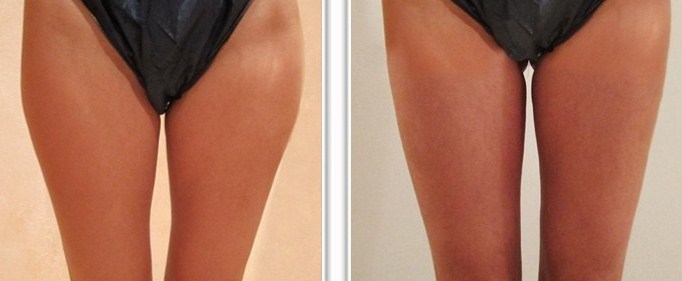 Liposuccion des faces internes et externes des cuisses (culotte de cheval)
