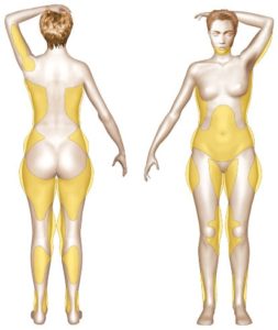 Zones traditionnellement traitées par la liposuccion