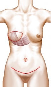 Reconstruction du sein avec le muscle grand droit et la peau correspondante en position (en rouge les cicatrices laissées par la reconstruction)