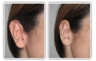 Résultat d'une chirurgie des oreilles décollées