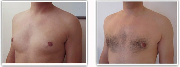 Résultat d'une operation pour adipo-gynecomastie chez un homme