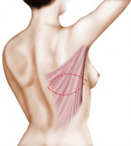 Zone de prélèvement du muscle grand dorsal