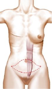 Zone de prélèvement de la peau abdominale avec le muscle grand droit