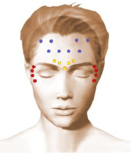 Zones d'injection de toxine botulique