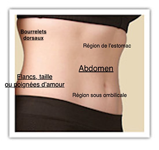 Schéma des parties du ventre pouvant être traitées par liposuccion