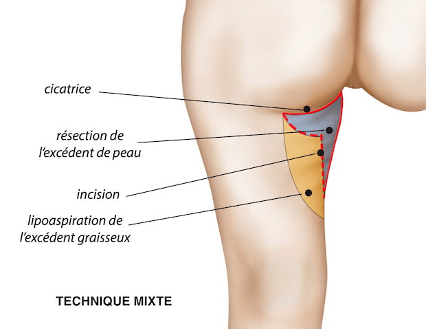Association des 2 incisions (verticale et horizontale) dans les cas d'un amaigrissement majeur