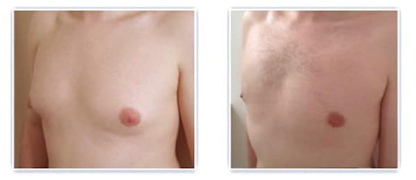 Autre résultat après traitement chirurgicale gynecomastie bilatérale mixte
