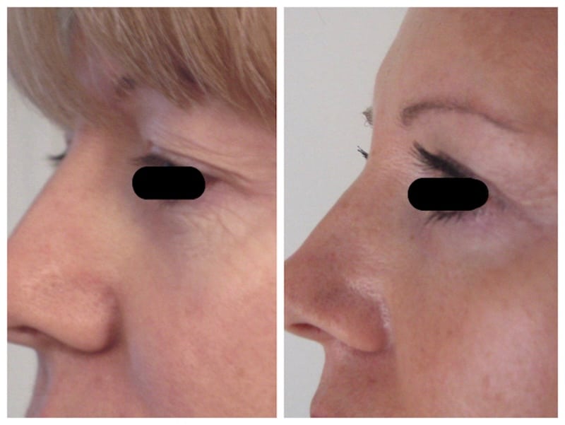 blépharoplastie supérieure avant-après