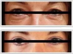 Résultat d'une blépharoplastie des paupières supérieures et inférieures