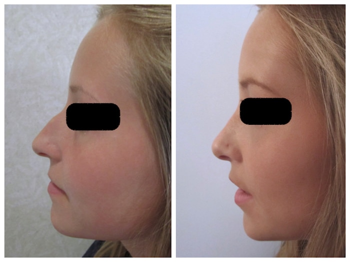 chirurgie-esthetique-nez