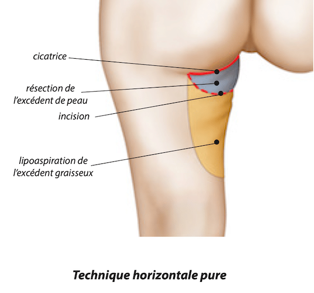 Disposition de la cicatrice du lifting de cuisses dans la technique horizontale pure