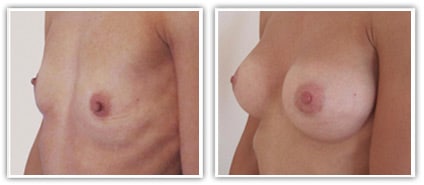 Hypotrophie ou hypoplasie mammaire bilatérale sévère traitée par prothèses