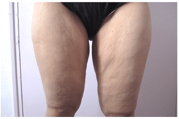 Exemple de cuisses traitées par lifting de cuisses