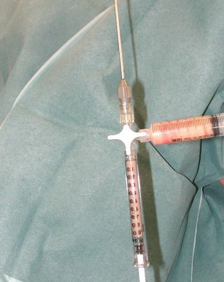 graisse lipofilling seringue d'injection