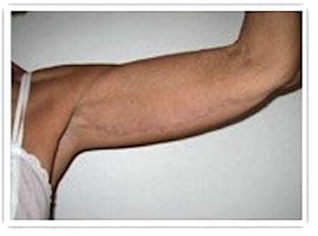 aspect des cicatrices quelques mois après un lifting de bras