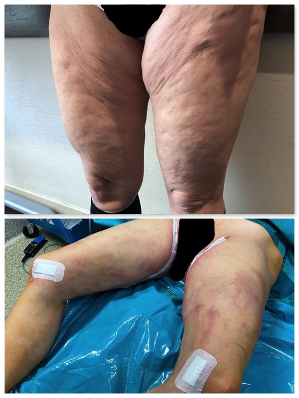 Résultat avant-après: la photo a été prise juste en fin d'intervention d'un lifting de cuisses