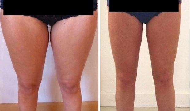 Résultat d'une lipoaspiration des genoux rejoignant une lipoaspiration circulaire des cuisses