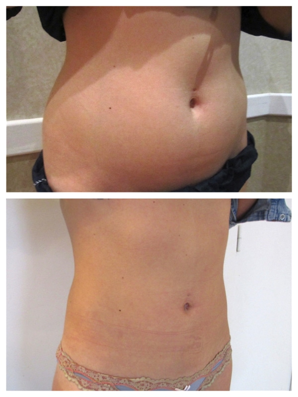 Résultat avant-après d'une liposuccion du ventre et de la taille