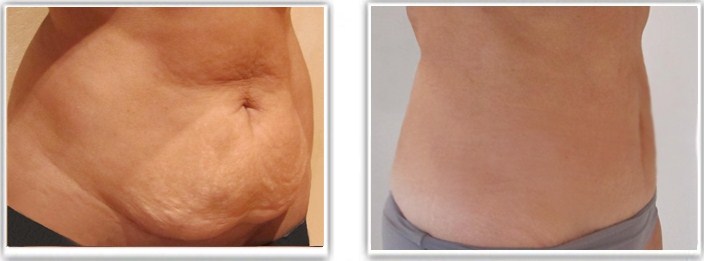 Liposuccion abdominale avec mini-abdominoplastie