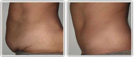 Résultat d'une abdominoplastie chez une femme après grossesse