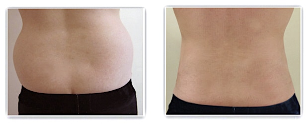 Résultat d'un affinement de la taille par lipoaspiration