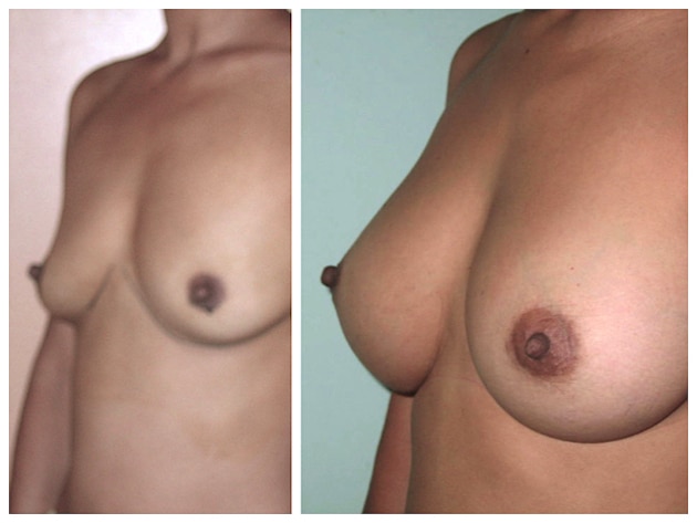 r&eacute;sultat avant apr&egrave;s augmentation mammaire implants 330cc