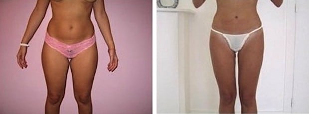 Résultat d'une liposuccion du ventre et de la taille associée à une liposuccion des cuisses (culotte de cheval)