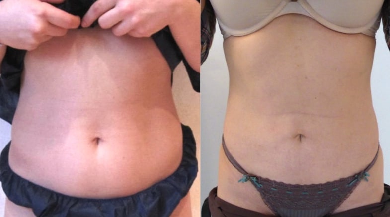 Résultat d'une correction des hanches par lipoaspiration des flancs