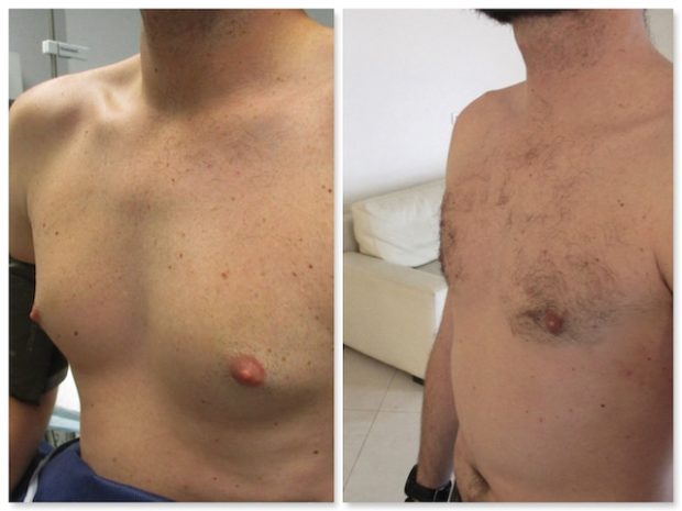 Resultat final d'une operation d'adipomastie et de gynecomastie chez un homme