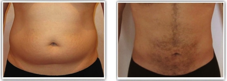 Résultat de lipoaspiration du ventre et des flancs (poignées d'amour) chez un homme
