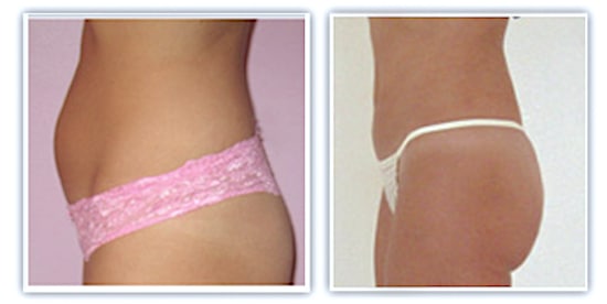 Résultat d'une liposuccion du ventre chez une femme