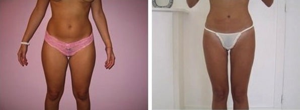 Résultat d'une liposuccion circulaire des cuisses, des hanches et du ventre chez une femme