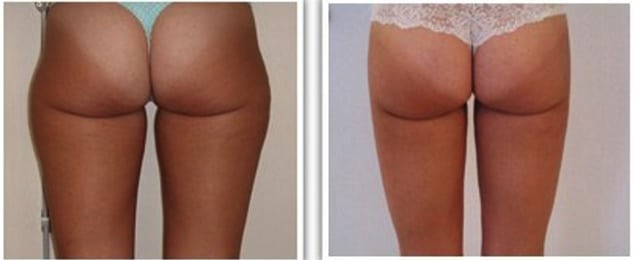 Résultat de liposuccion à 6 mois