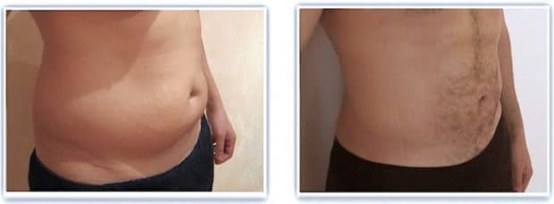 Résultat avant après lipoaspiration du ventre chez un homme