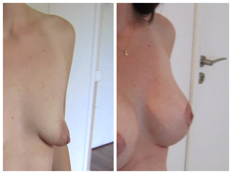 mastopexie et implants mammaires