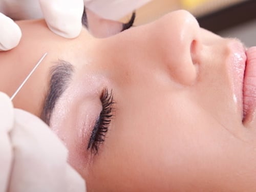 injection de Botox au niveau de la ride du lion